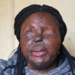 acid-attack-woman