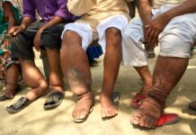 Zimbabwe battles another deadly disease: Elephantiasis that is spread through mosquito bites hits schools hard