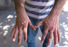 Mpox hits Zimbabwe as government confirms 2 cases in Harare and Mberengwa