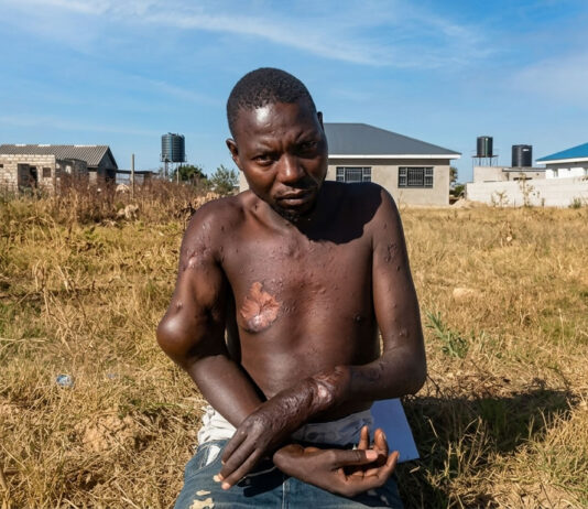 Stealing fish in Lake Chivero ends in tears: Norton man now disabled after fighting with a deadly crocodile for 30 minutes